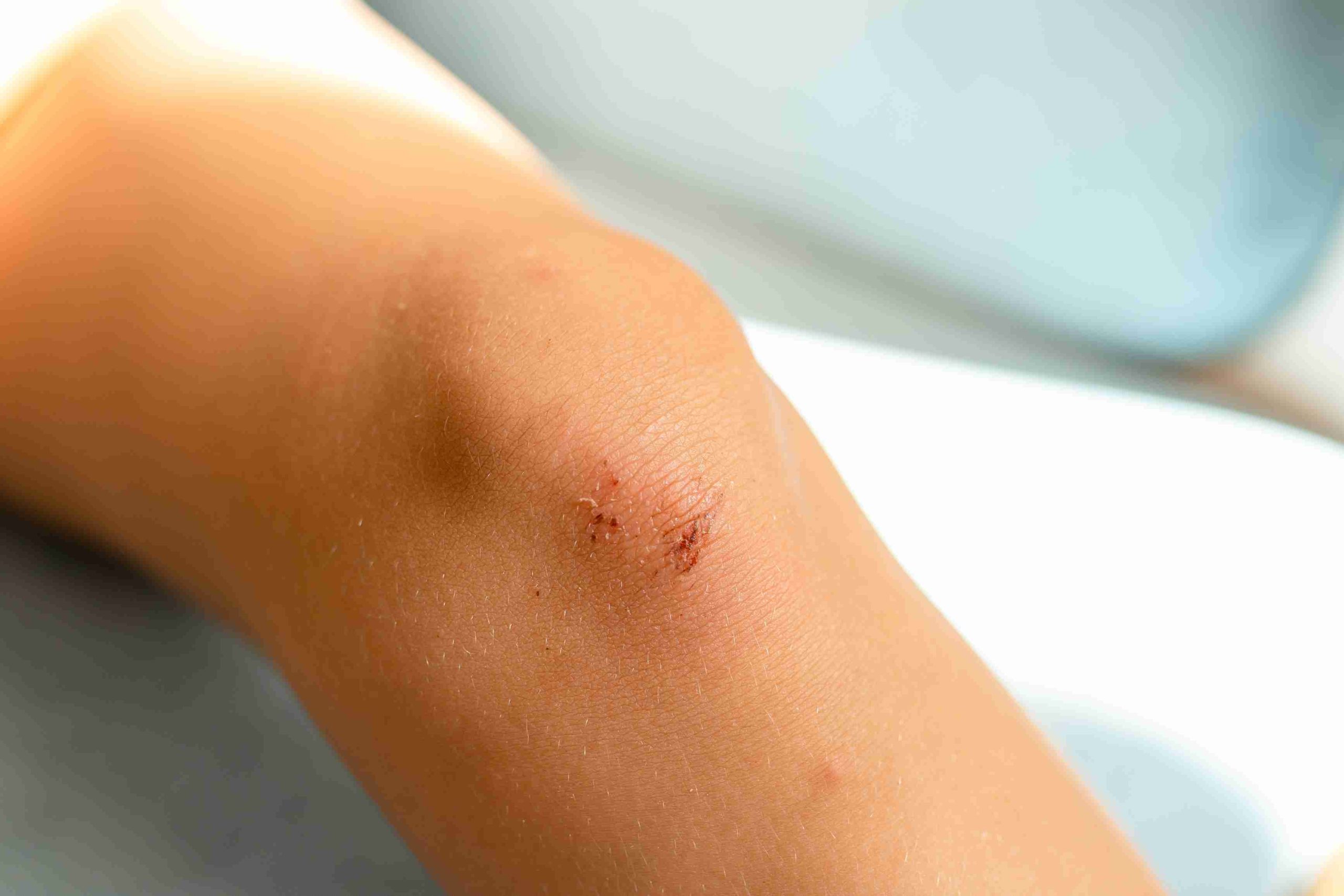  Pueraria Mirifica and Wound Healing Explained